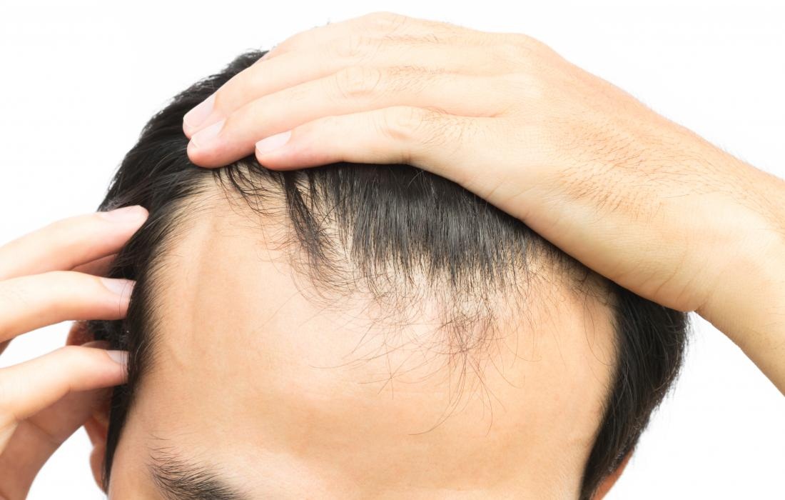 What causes sudden hair loss? Can it be reversed?