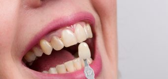 Do Dental Implants Stain Or Discolor?