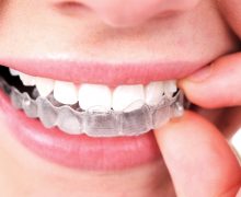 How Old Should A Patient Be For Invisalign?