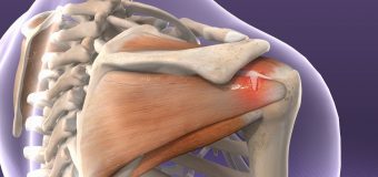 Major Causes of Rotator Cuff Injury