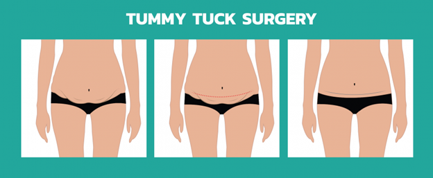 Abdominoplasty, What To Expect