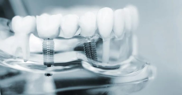 Can You Have Dental Implants? Here Is What You Should Know