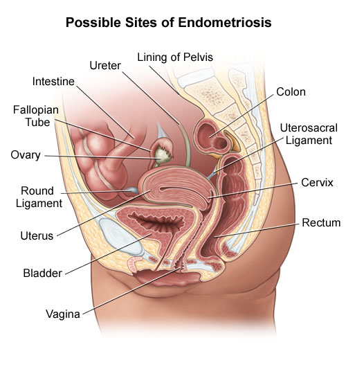 Endometriosis and how it affects the body