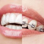 Understanding the Comparison Between Invisalign and Traditional Braces