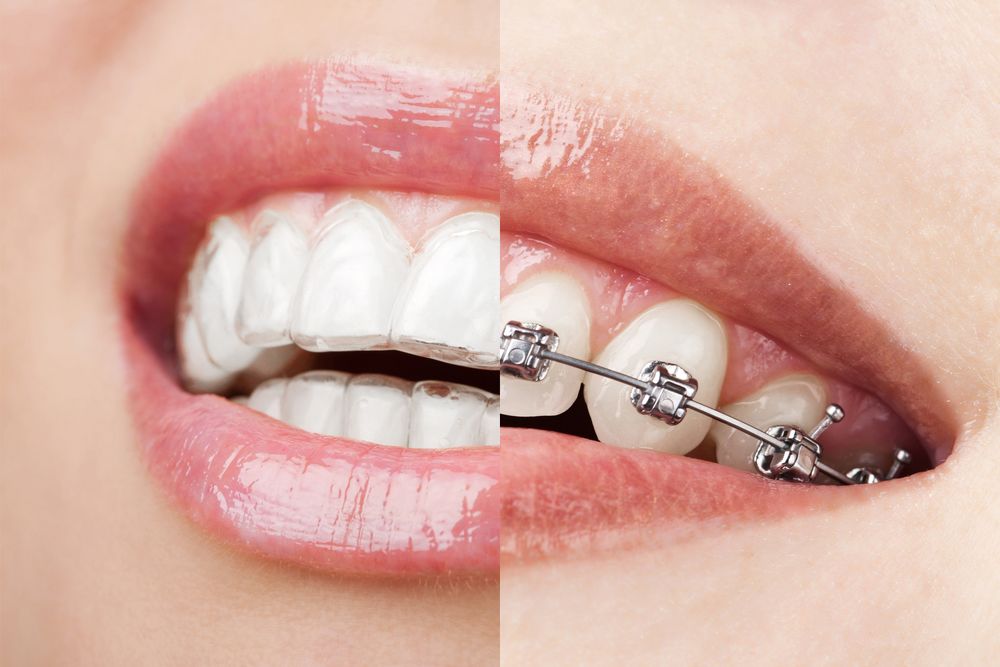 Understanding the Comparison Between Invisalign and Traditional Braces